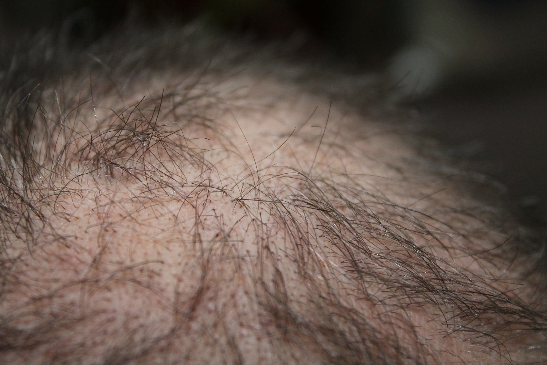 How To Prevent Hair Loss