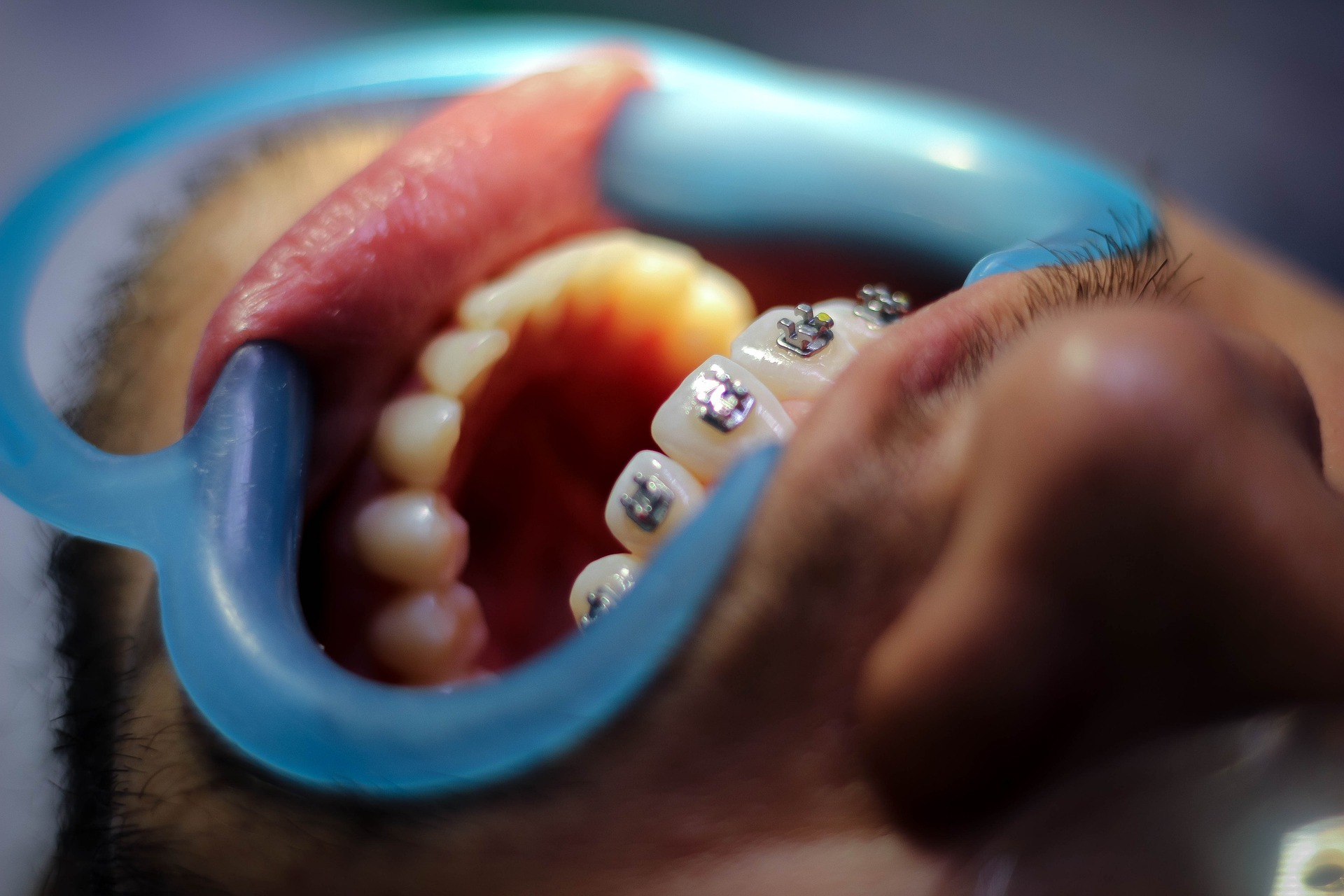 7 Powerful Advantages of Braces Besides Straight Teeth