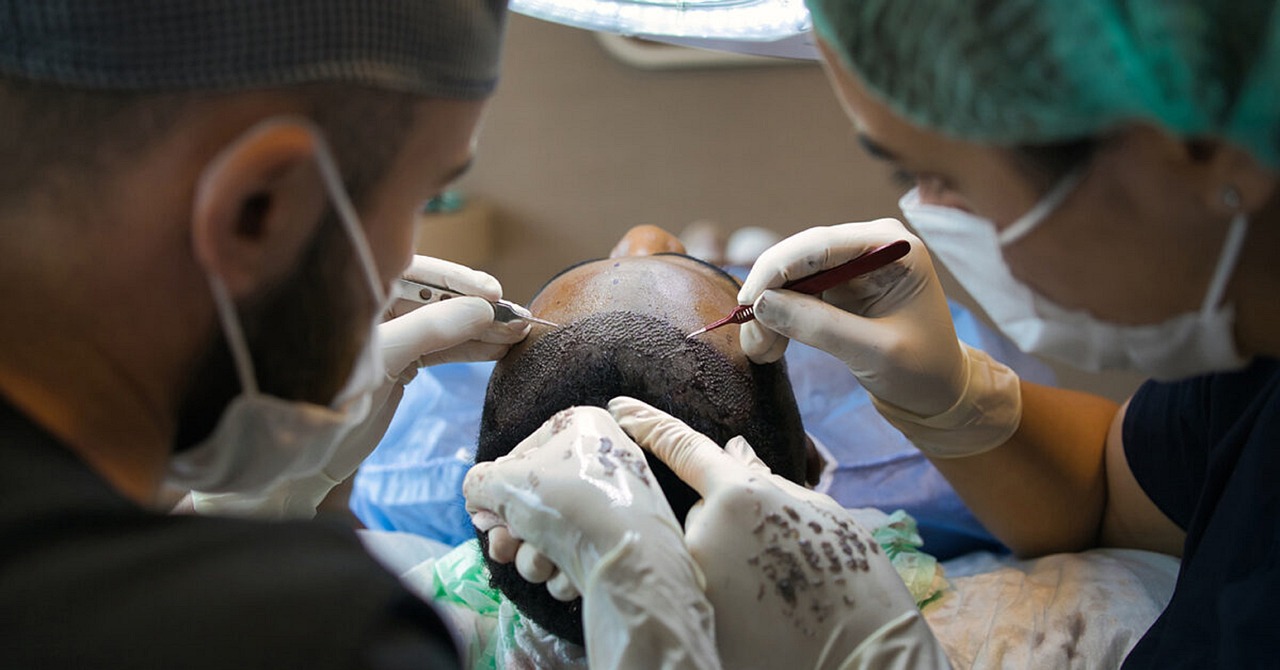 How hair transplants can combat hair loss