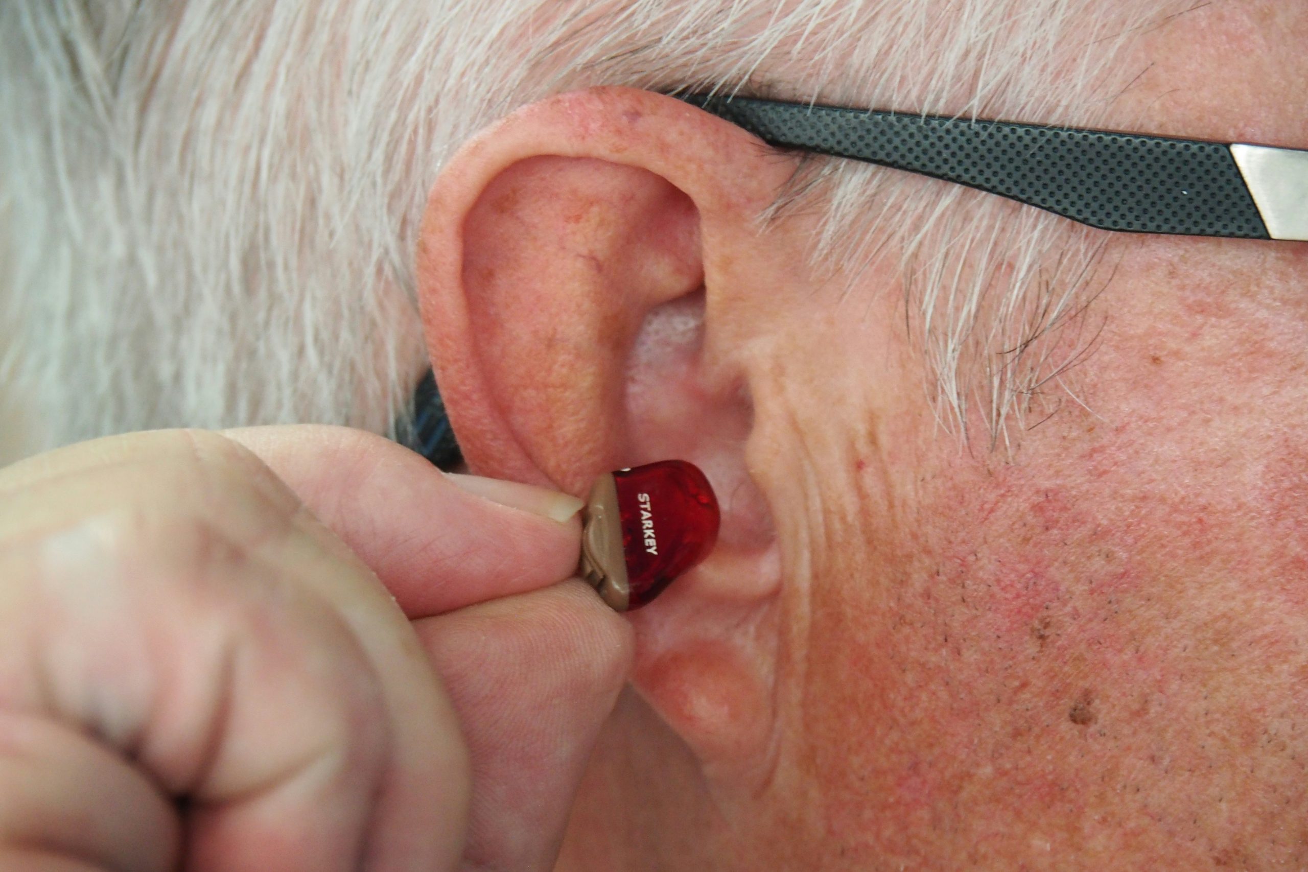 Tepezza Dilemma: Navigating the Debate on Permanent vs. Temporary Hearing Loss Effects