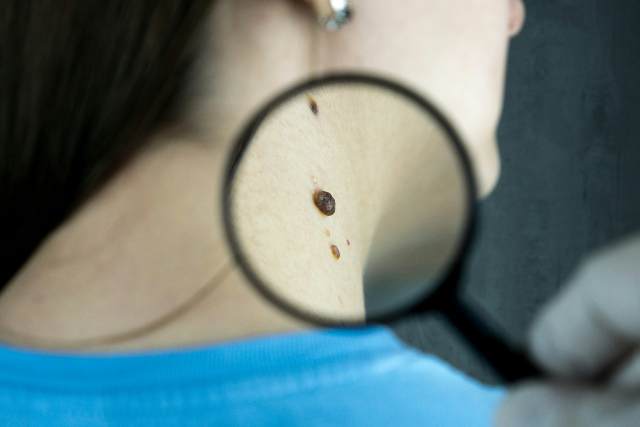 What Does a Skin Check Clinic Do? Understanding Their Role in Skin Health