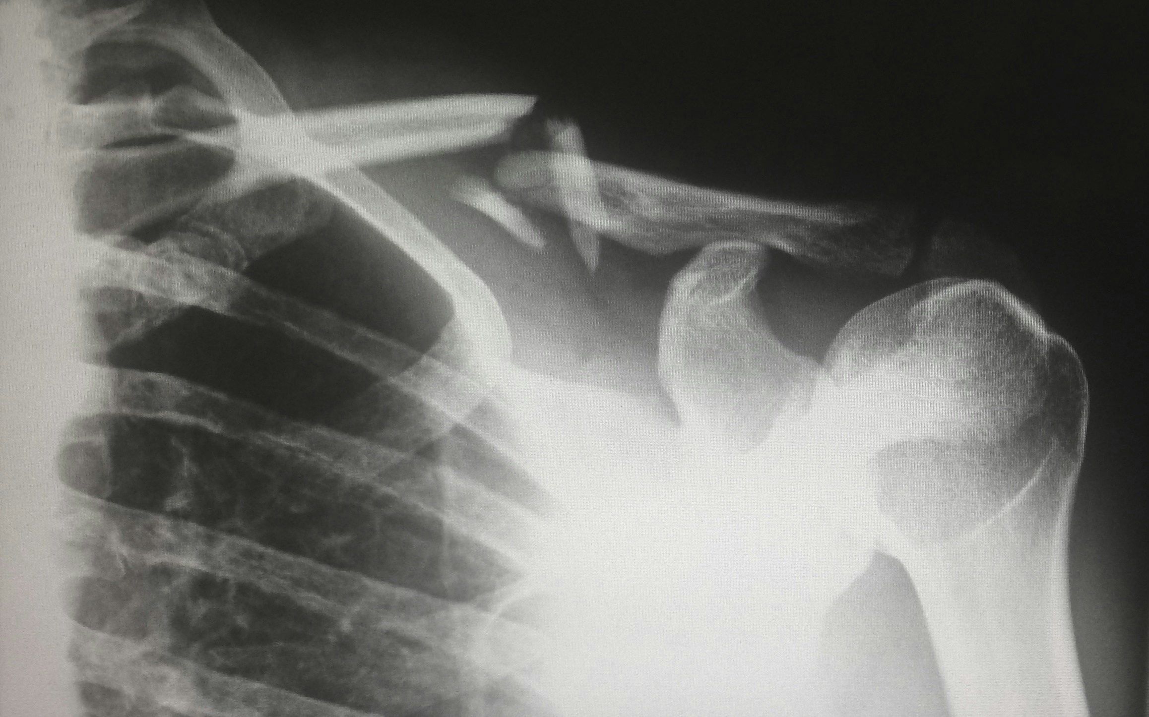 Steps to Take When You Think You’ve Broken a Bone