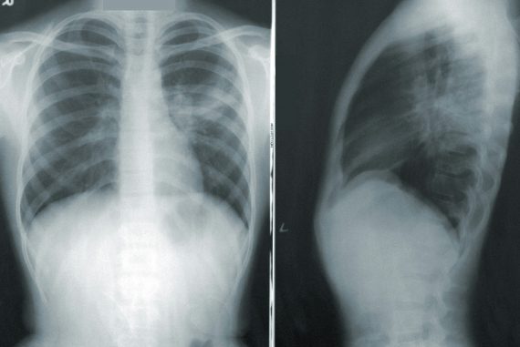 Bone Scan