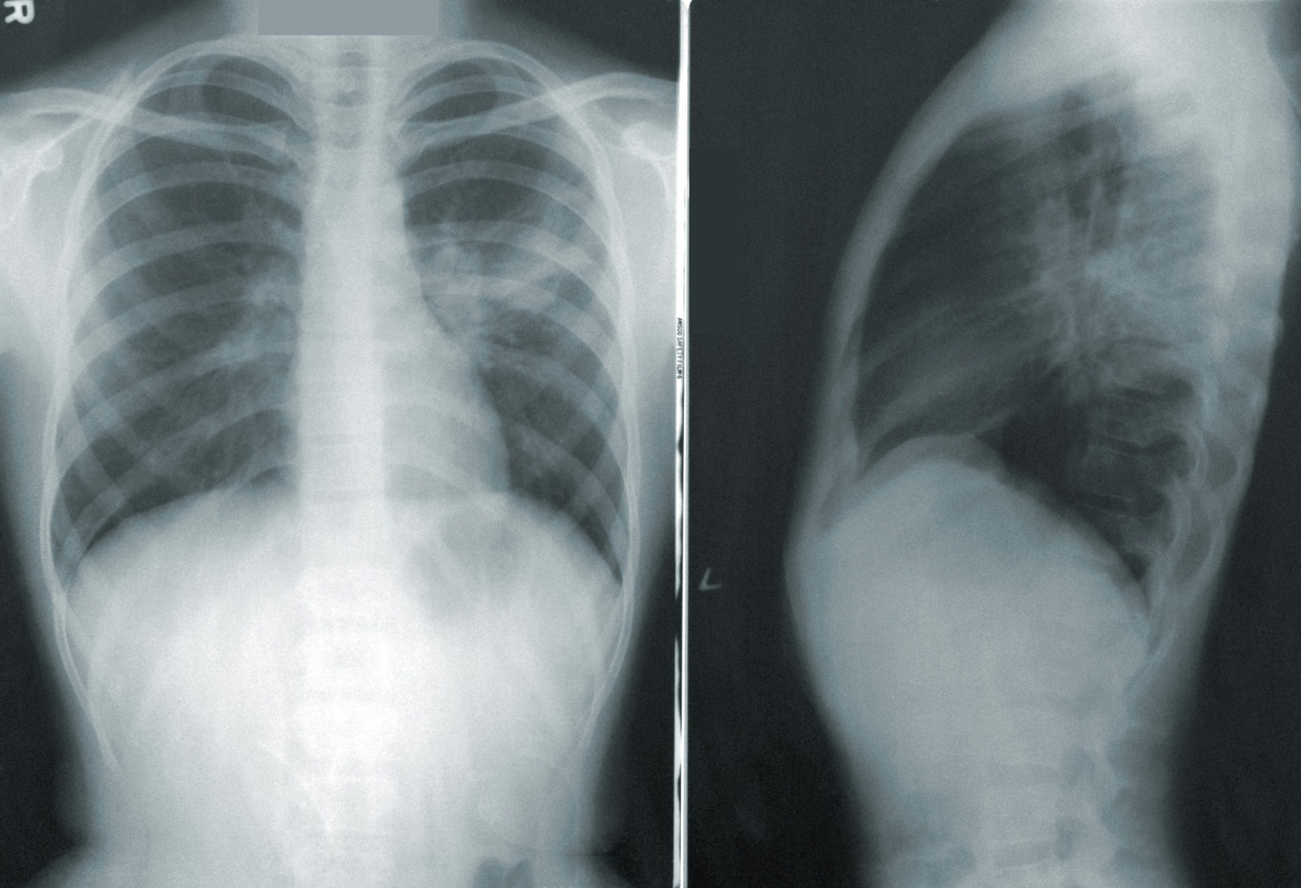 Bone Scans Explained: A Step-by-Step Look at the Procedure
